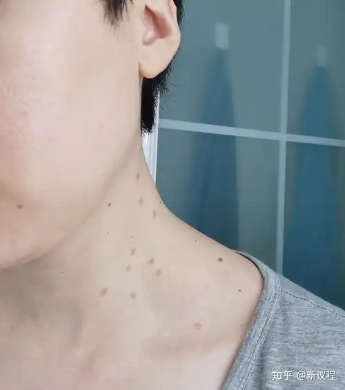 产后脖子丝状疣处理记录 - 知乎