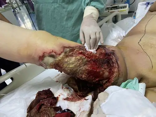 一例极速进展性皮肤坏死病例分享