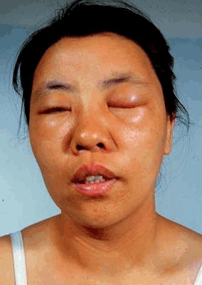 颜面复发性皮炎(面部过敏性复发性潮红综合症)的中药治疗