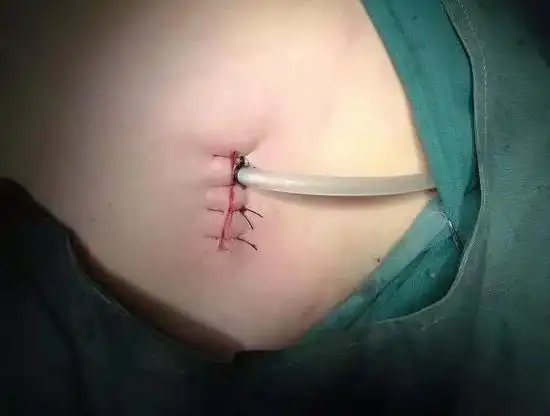 运城市第一医院胸外科成功完成单孔胸腔镜手术