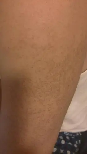 09:58李龙医师 回答: 病情分析: 你好,你说的情况是毛囊炎感染的