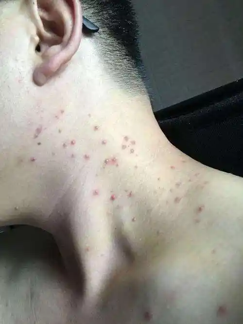 号称"不死癌症"的毛囊炎, 真的摆脱不掉吗?