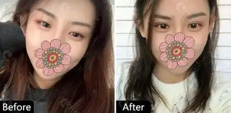 郑州天后割双眼皮前后对比照