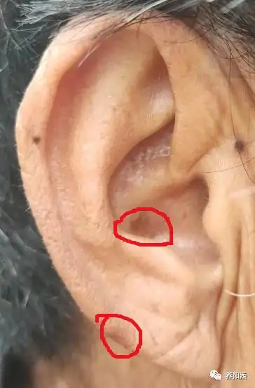 中医综合望诊-耳诊 ·五臓六腑穴位-肺 黄丽春 69