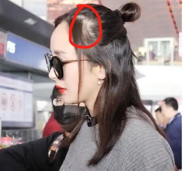 头顶上秃顶头发少了一片儿都不知道吗啊?网友直呼:工作太劳累吧!