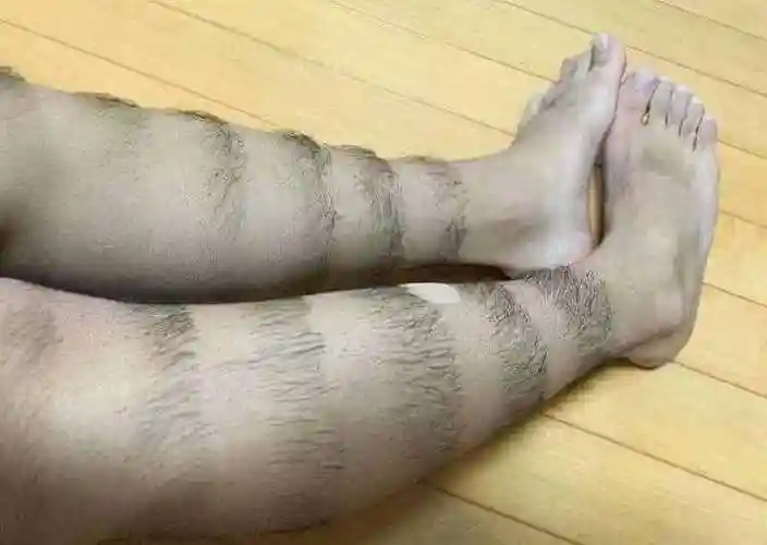 腿毛旺盛和腿毛稀少,与什么原因有关?