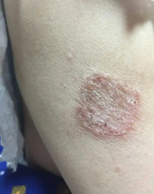 体癣真的会传染吗?该怎么办?