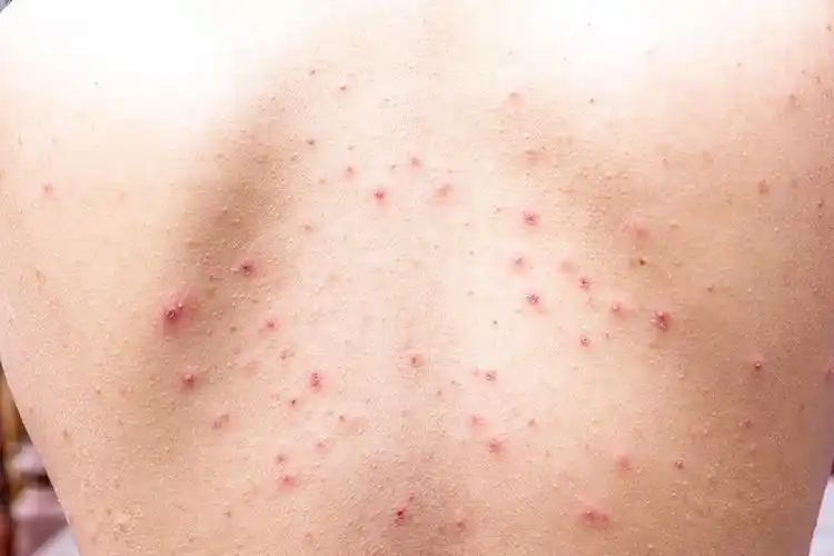 背上反复长痘痘有什么有效方法祛除痘痘和痘印吗