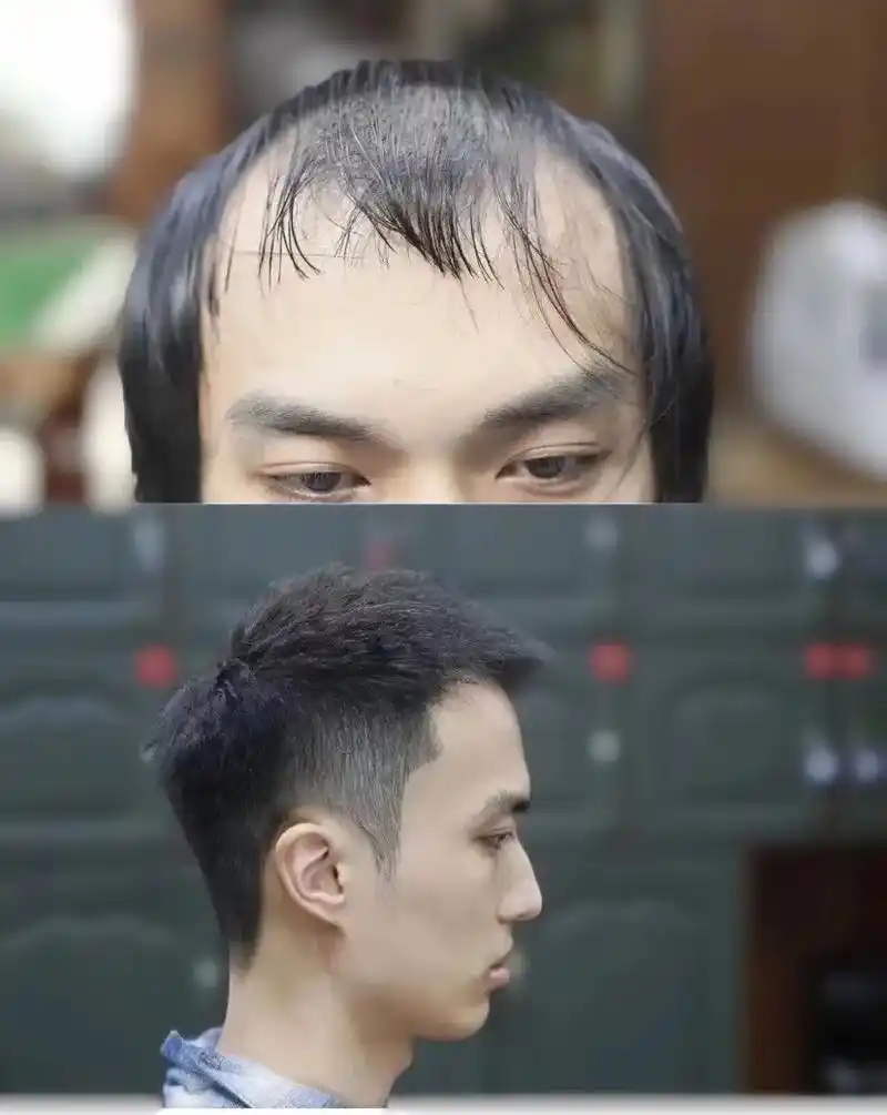 发际线偏高,m型发际线,头顶头发稀少. 选对 - 抖音