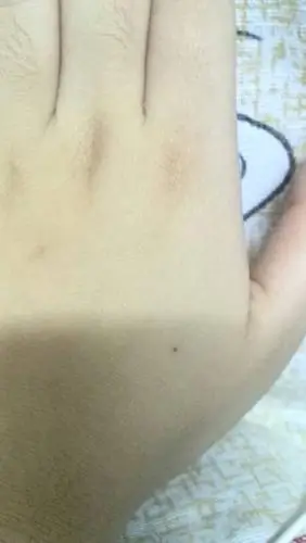 就是好奇 左手背上长个痣 怎么回事呀