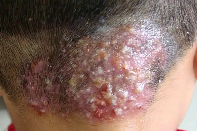 1,细菌性毛囊炎细菌感染是感染性毛囊炎最常见的病因,早期临床表现为