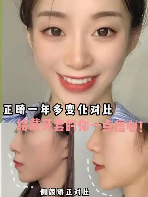 一年多变化对比,给戴牙套的你一点信心!