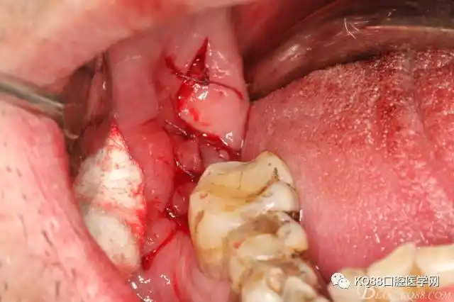下颌倒置埋伏智齿的拔除
