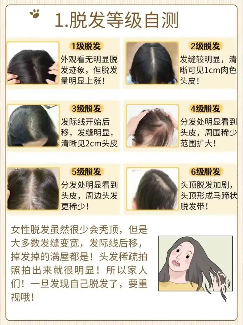 脱发等级自测