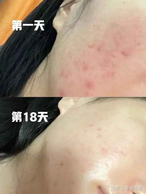 可可缇亚水杨酸祛痘棉片