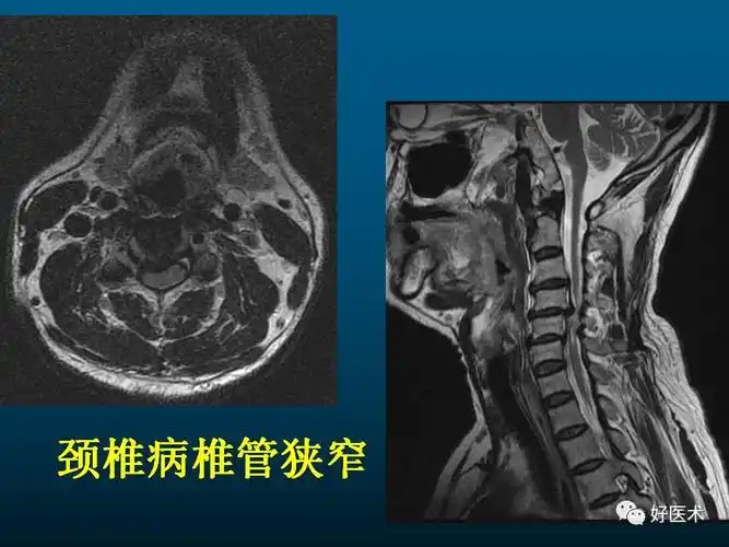 颈椎病的mri诊断技巧