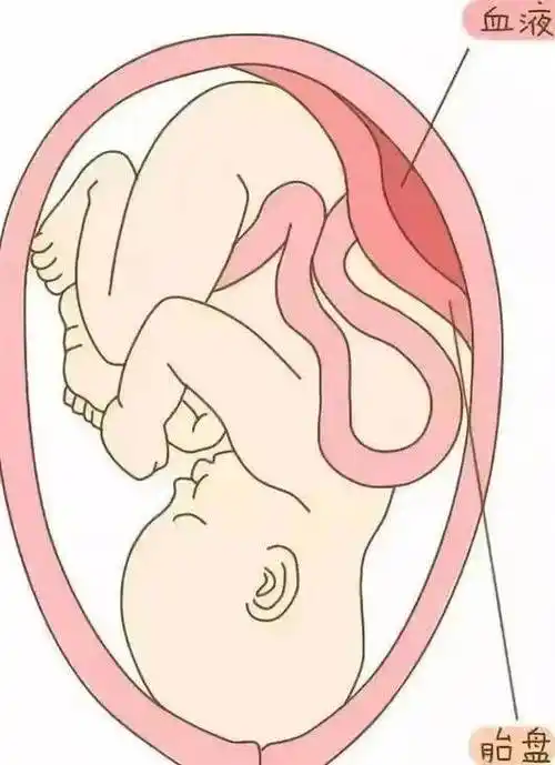 二胎妈妈突发胎盘早剥,多学科展开生死营救