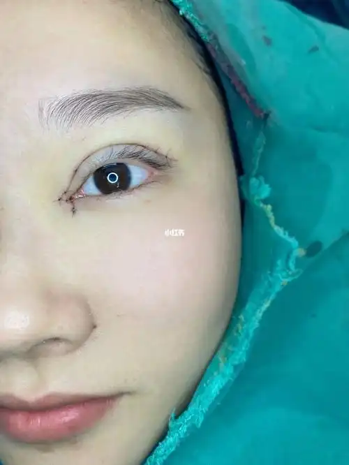 双眼皮术后即刻照#双眼皮_双眼皮_美妆_医美整形