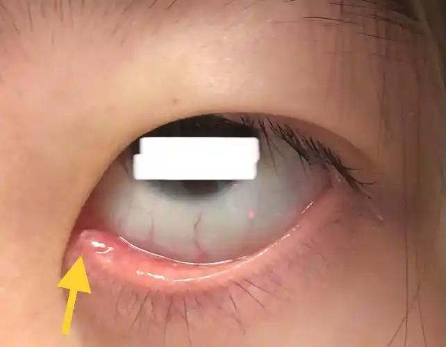 眼睑肿块之下眼睑内侧泪点旁霰粒肿的治疗&时机和原则 - 好大夫在线