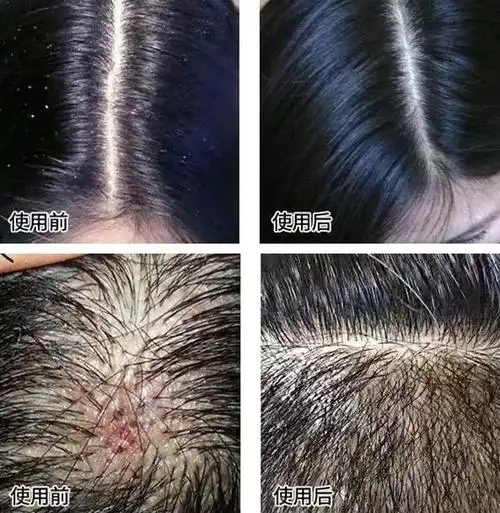 感觉头皮身上有虫爬头发越掉越少千万要小心了