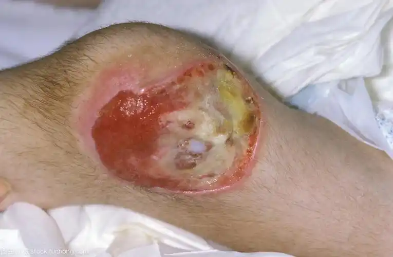 50岁老人感染艾滋病,却是因为十年前犯的错,潜伏期原来这么长