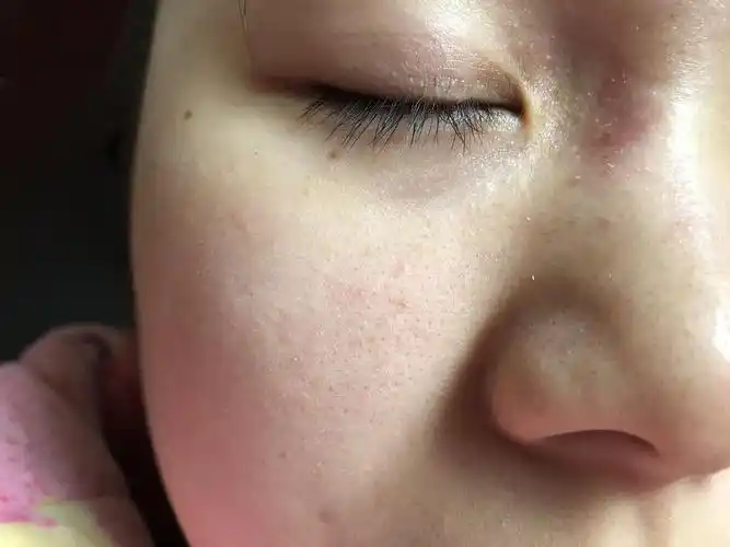 请问这些黑头闭口粉刺怎么去啊