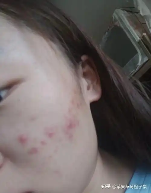 脸上一直不停反复长痘又痒又疼的怎么办急急急