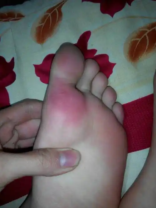 脚底板变红而且还有泡