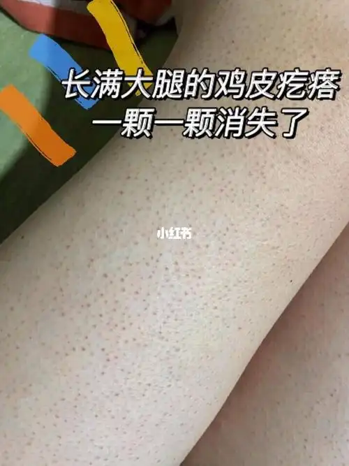 鸡皮肤一锅踹了被问800遍的去鸡皮方法