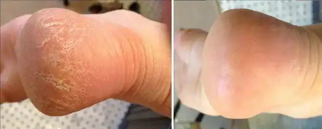 角质|角质层_网易订阅