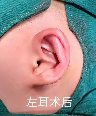 3岁孩子"没有耳朵",医生手术让耳朵重新"长"出来!