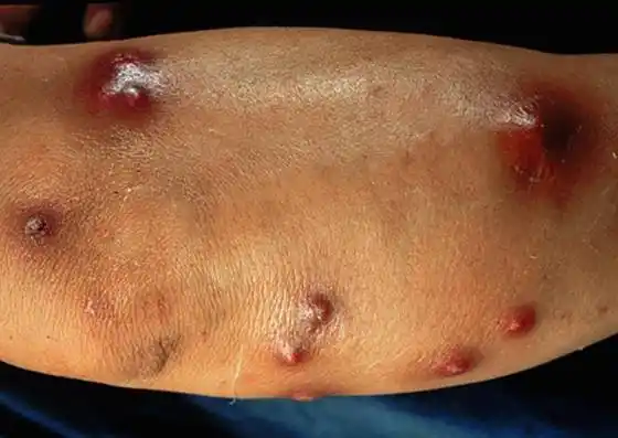 局部治疗早期外搽鱼石脂软膏,2.5%碘酊等.