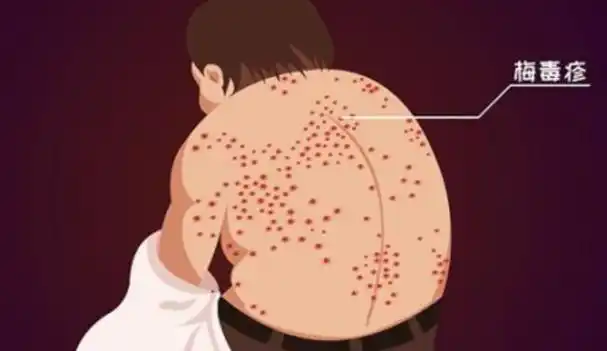 身上会痒吗?梅毒可以治愈吗?建议了解一下