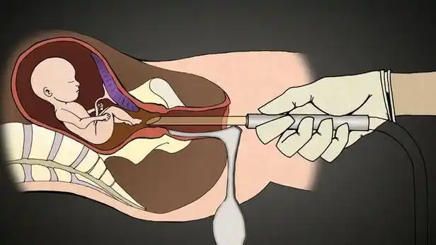 人工流产后,那些被打掉的胎儿都去哪了?真相太残忍!