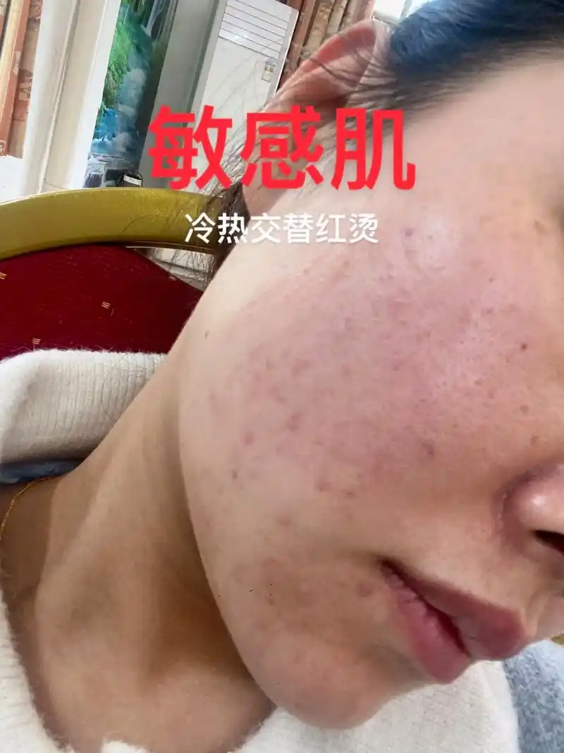 玫瑰痤疮77脂溢性皮炎加上爆痘,这个过程,这个心酸,真不是一般 - 抖