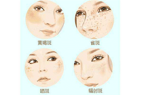 脸部色斑形成的原因以及改善方法