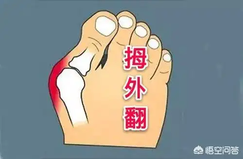 拇外翻是什么