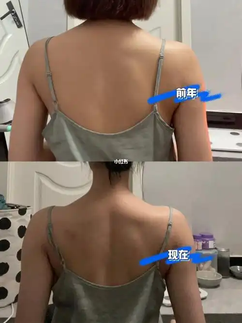 现在的背和肩颈比之前好很多了但是后面两块凸起的肌肉不知道是斜方肌