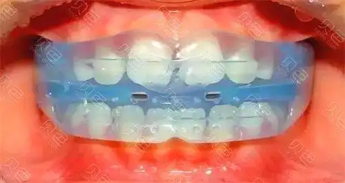 国外禁用儿童mrc矫正器是真的吗了解mrc的利弊就明白了