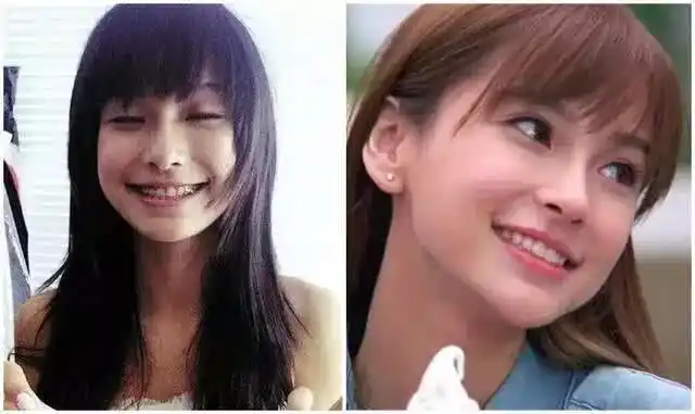 杨超越戴牙套合不上嘴,肖战矫正兔牙,杨紫曾当众摘下牙套