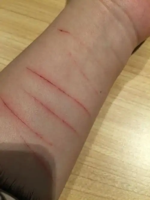 用刀割伤,用什么不能留疤痕,我不是疤痕体质,谁有好爆发告诉我一下