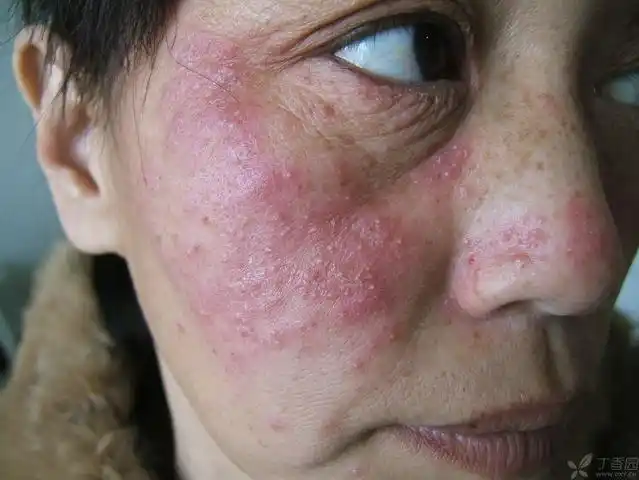 皮肤与性传播疾病讨论版 -丁香园论坛