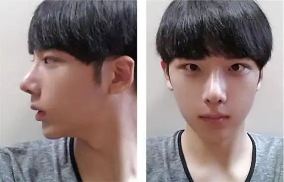 韩国男生整容案例恢复效果惊人