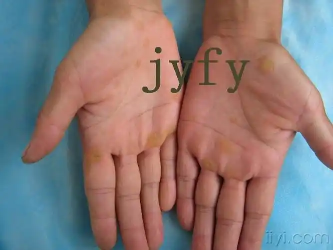 点状掌跖角化症