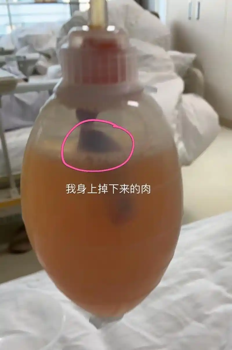 小有名气的大夫说我是他治过最严重的乳糜漏