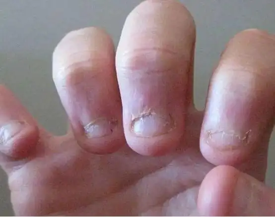 8岁小孩为什么喜欢咬指甲怎样可以戒掉啃指甲