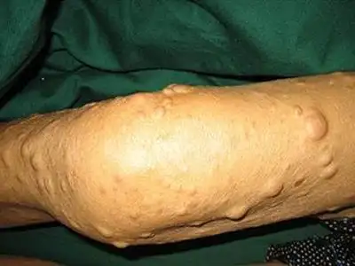 手臂皮下脂肪瘤图片