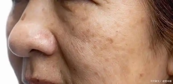 绵阳肤健皮肤病专科医院:女性最爱长这4种斑,早知晓早预防!
