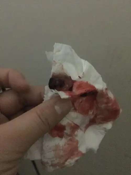 40天药流排出孕囊图片 - 搜狗图片搜索