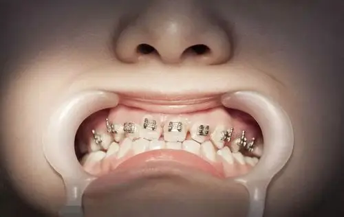 酷育儿│儿童牙齿矫正的"黄金期",千万不要错过